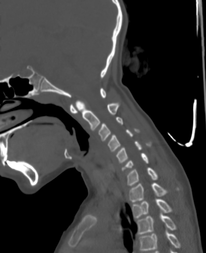 Butterfly vertebra (Radiopaedia 77903-90209 Sagittal bone window 37).jpg
