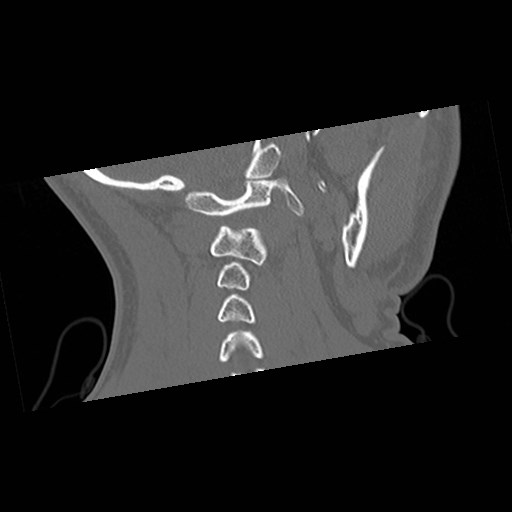 File:C1-C2 "subluxation" - normal cervical anatomy at maximum head rotation (Radiopaedia 42483-45607 Coronal non-contrast 44).jpg