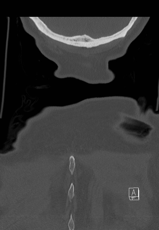 C1 and C2 (peg) fractures (Radiopaedia 36618-38184 Coronal bone window 59).jpg