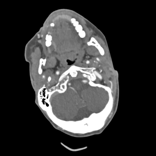 File:C2 fracture with vertebral artery dissection (Radiopaedia 37378-39200 A 184).png