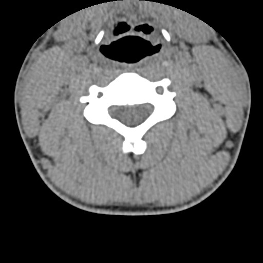 File:C5 facet fracture (Radiopaedia 58374-65499 Axial non-contrast 44).jpg
