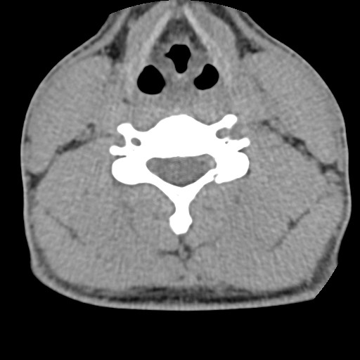 C5 facet fracture (Radiopaedia 58374-65499 Axial non-contrast 53).jpg