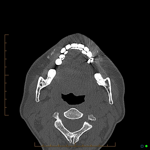 Calcified facial augmentation fillers (Radiopaedia 79514-92679 Axial bone window 112).jpg