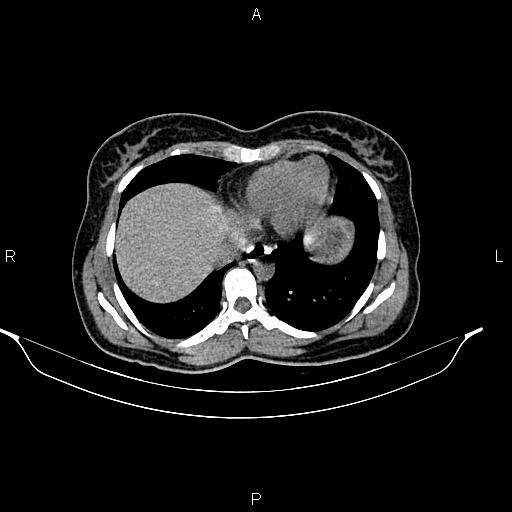 File:Calcified hepatic hydatid cyst (Radiopaedia 84672-100095 Axial non-contrast 12).jpg