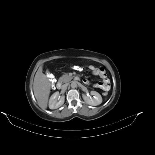 File:Calcified hydatid cyst of the liver (Radiopaedia 21212-21112 Axial C+ delayed 21).jpg
