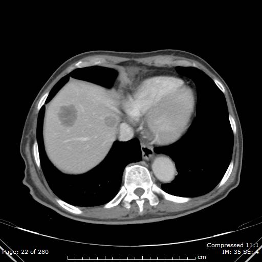 Calcified liver metastases (Radiopaedia 44699-48470 B 8).jpg