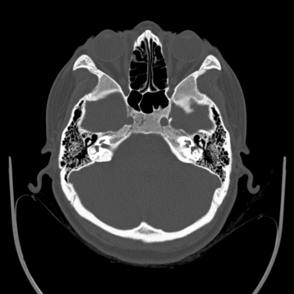 Calvarial osteoma (Radiopaedia 36520-38079 Axial bone window 27).jpg