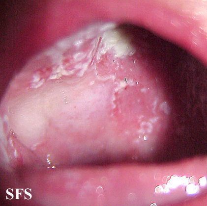 File:Candidiasis (Dermatology Atlas 15).jpg