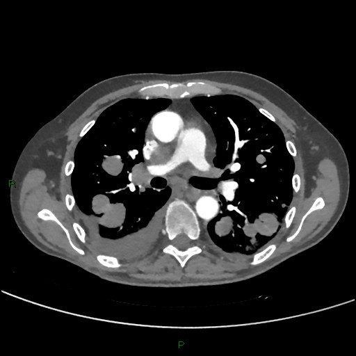 Cannonball metastases (Radiopaedia 82110-96150 Axial C+ CTPA 150).jpg