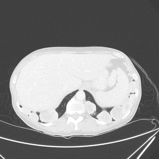 Canonball lung metastasis (Radiopaedia 77634-89837 Axial lung window 164).jpg