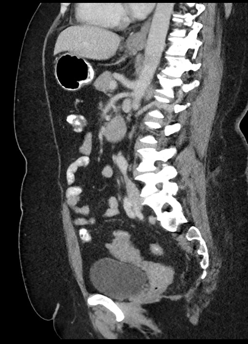 Carcinoid tumor - terminal ileum (Radiopaedia 60931-68739 C 42).jpg
