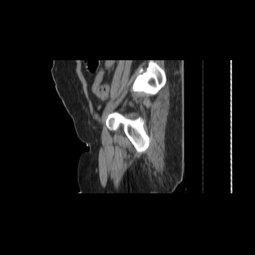 File:Carcinoma cervix- brachytherapy applicator (Radiopaedia 33135-34173 D 153).jpg