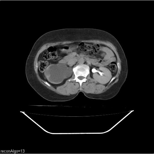 Carcinoma cervix- recurrence (Radiopaedia 34702-36137 B 72).jpg