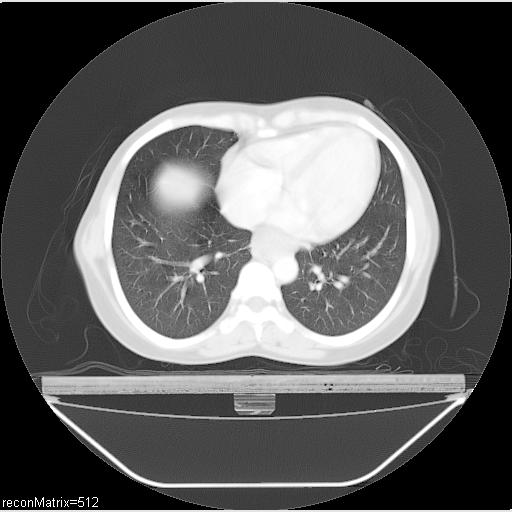 File:Carcinoma of esophagus (Radiopaedia 27356-27550 Axial lung window 13).jpg
