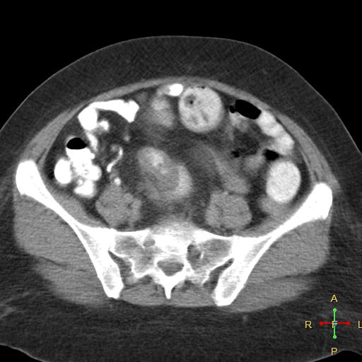 File:Carcinoma of sigmoid colon (Radiopaedia 23071-23100 C+ delayed 19).jpg