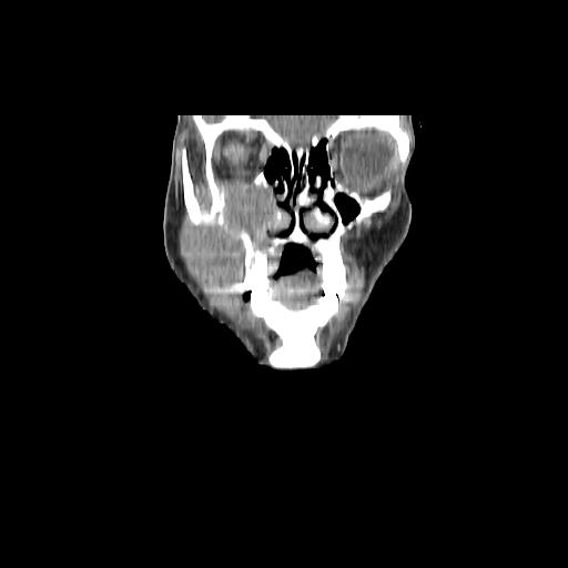 Carcinoma of the maxillary antrum (Radiopaedia 53805-59888 Coronal C+ delayed 28).jpg