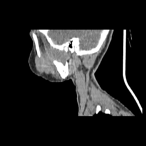 Carcinoma of the maxillary antrum (Radiopaedia 53805-59888 Sagittal C+ delayed 43).jpg