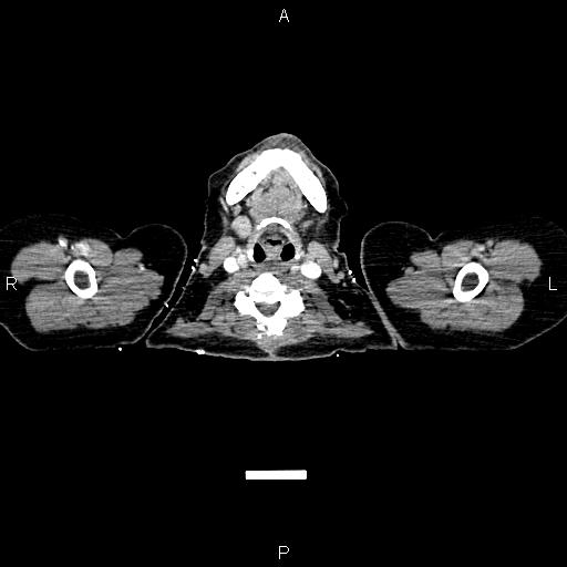 Carcinoma of uterine cervix (Radiopaedia 85861-101700 A 1).jpg
