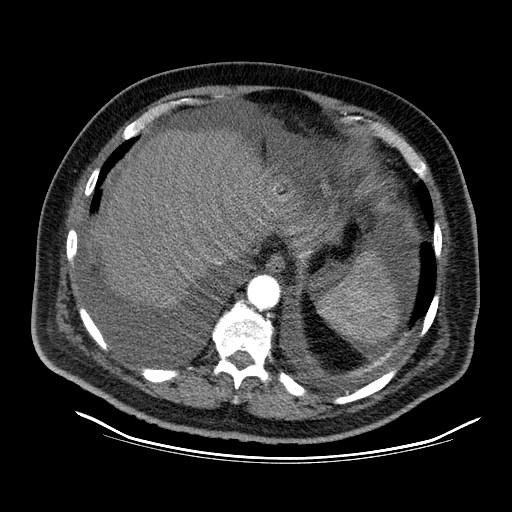 File:Cardiac lymphoma (Radiopaedia 38690-40836 Axial C+ CTPA 19).jpg