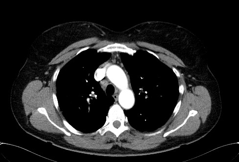Cardiac sarcoidosis (Radiopaedia 74548-85534 A 25).jpg