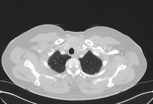 Cardiac sarcoidosis (Radiopaedia 74548-85534 Axial lung window 9).jpg