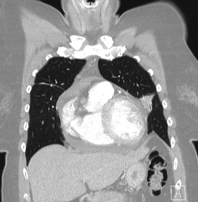 Cardiac sarcoidosis (Radiopaedia 74548-85534 Coronal lung window 17).jpg
