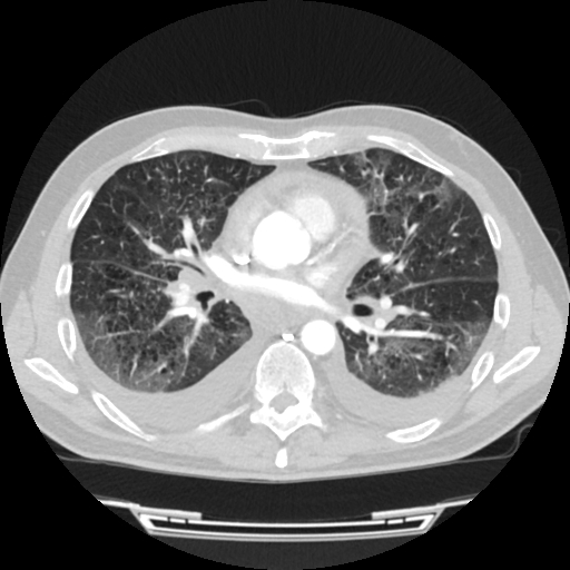 Cardiac tamponade (Radiopaedia 78607-91368 Axial lung window 45).jpg