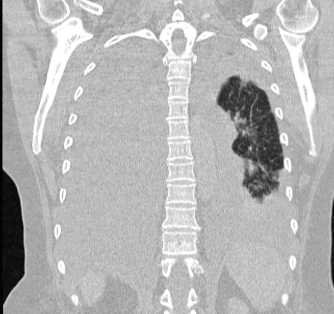 Cardiogenic pulmonary edema (Radiopaedia 29213-29609 Coronal lung window 50).jpg
