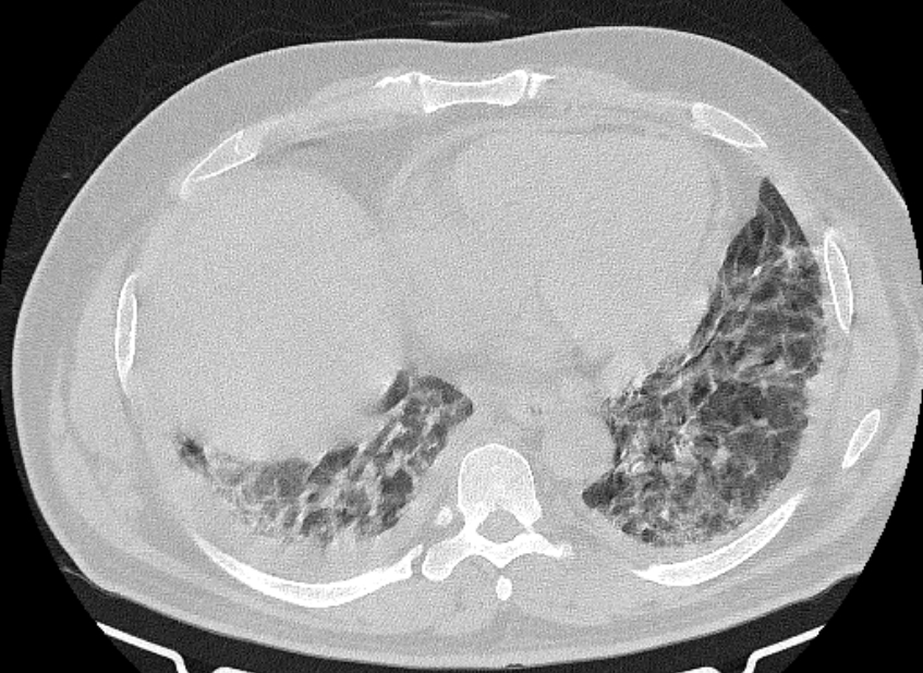 Cardiogenic pulmonary edema (Radiopaedia 68180-77678 Axial lung window 71).jpg