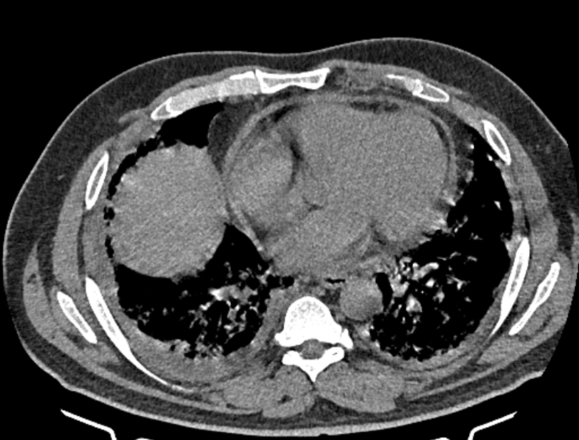 Cardiogenic pulmonary edema (Radiopaedia 68180-77678 Axial non-contrast 32).jpg