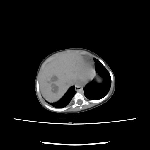 Caroli disease with autosomal recessive polycystic kidney disease (ARPKD) (Radiopaedia 89651-106703 E 21).jpg