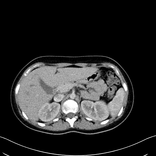 Caroli disease with medullary sponge kidney (Radiopaedia 82622-96804 C 24).jpg