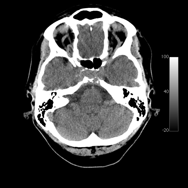 Caroticocavernous fistula (Radiopaedia 14617-14542 Axial non-contrast 7).jpg