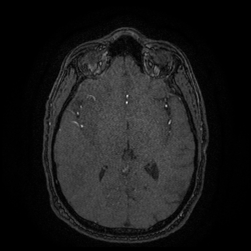 Carotid arterial dissection with acute cerebral infarction (Radiopaedia 26636-26784 MRA 78).jpg