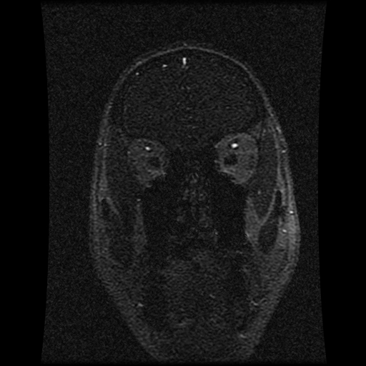 Carotid arterial dissection with acute cerebral infarction (Radiopaedia 26636-26784 MRV 131).jpg