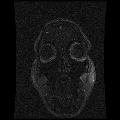 Carotid arterial dissection with acute cerebral infarction (Radiopaedia 26636-26784 MRV 140).jpg