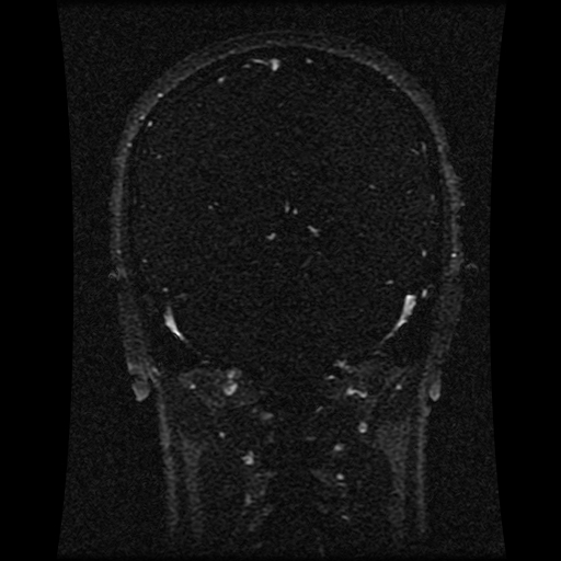File:Carotid arterial dissection with acute cerebral infarction (Radiopaedia 26636-26784 MRV 79).jpg