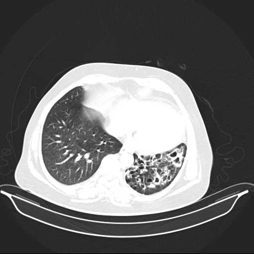 File:Carotid body tumor (Radiopaedia 21021-20948 Axial lung window 31).jpg