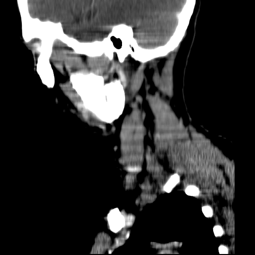 File:Carotid body tumor (Radiopaedia 27890-28124 C 2).jpg