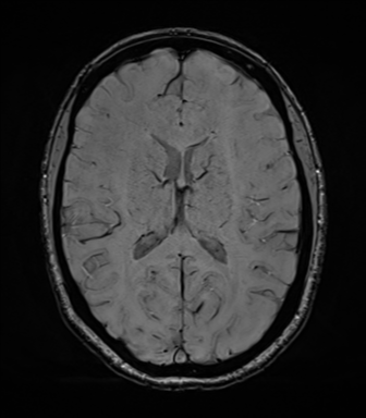 File:Cavernoma with bleed - midbrain (Radiopaedia 54546-60773 Axial SWI 28).png