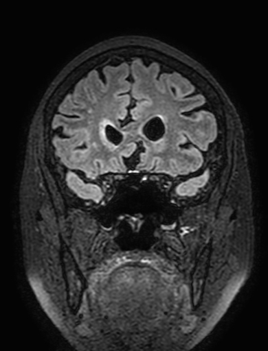 Cavernous hemangioma of the cerebellar falx (Radiopaedia 73025-83724 Coronal FLAIR 102).jpg
