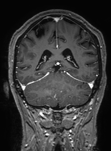Cavernous hemangioma of the cerebellar falx (Radiopaedia 73025-83724 Coronal T1 C+ 259).jpg