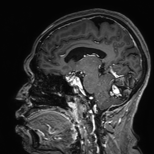 File:Cavernous hemangioma of the cerebellar falx (Radiopaedia 73025-83724 Sagittal T1 C+ 119).jpg