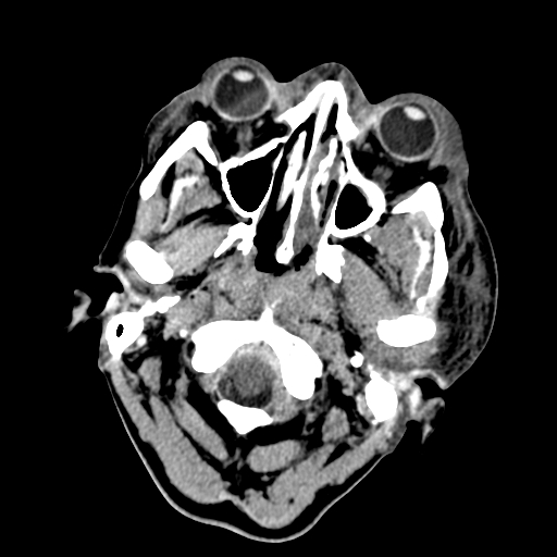 File:Cavernous sinus thrombosis (Radiopaedia 10619-11078 Axial non-contrast 1).jpg