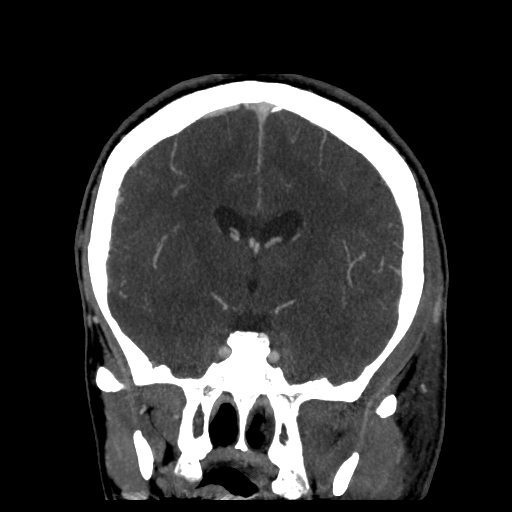 File:Cavernous sinus thrombosis (Radiopaedia 10619-11078 D 14).jpg
