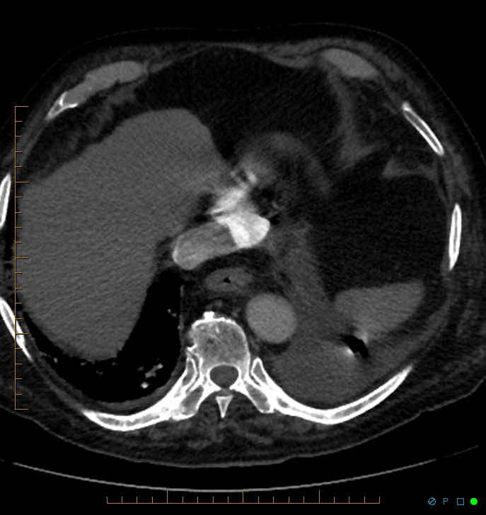Cavitating pulmonary infarction (Radiopaedia 54634-60849 Axial C+ CTPA 69).jpg