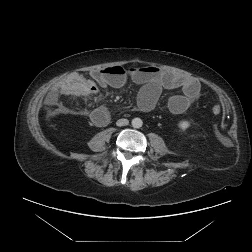 Cecal adenocarcinoma (Radiopaedia 64871-73817 A 57).jpg