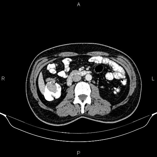 Cecal adenocarcinoma (Radiopaedia 85324-100916 B 45).jpg