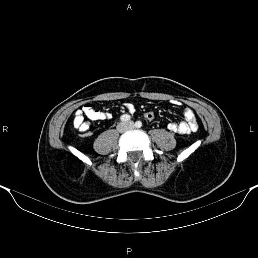 Cecal adenocarcinoma (Radiopaedia 85324-100916 B 61).jpg