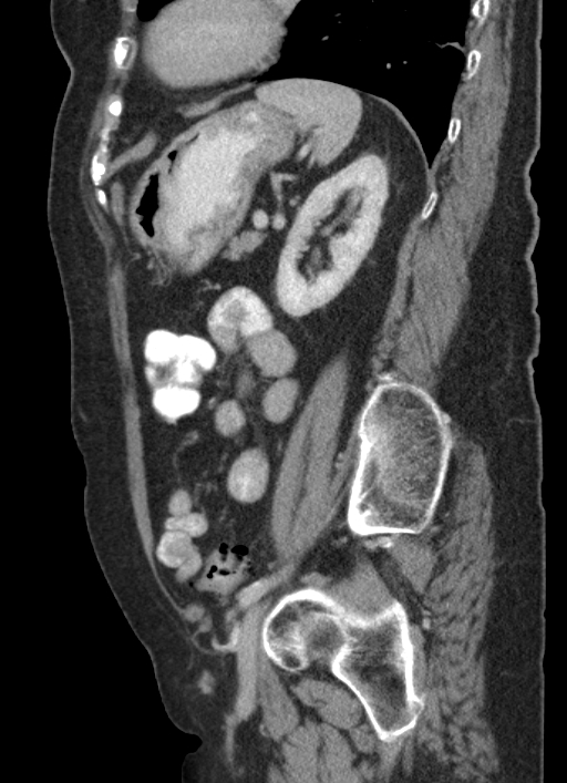 Cecal adenocarcinoma - surgical scar recurrence (Radiopaedia 79988-93264 D 20).jpg
